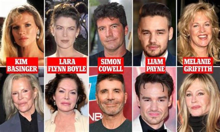 4 Celebrities Who Have Had A Thread Lift, Some May Shock You!