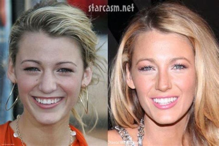 Blake Lively Nose Job Before and After
