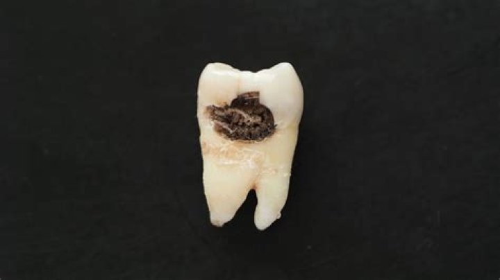 Como consertar dentes podres e 5 melhores maneiras de evitar a podridão