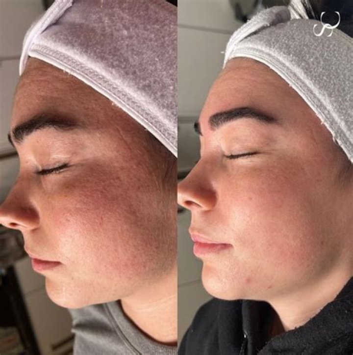 Dermaplaning; o que é e pra que serve? Salão de Beleza Cravo & Canela