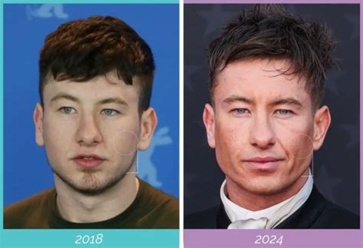 Has Barry Keoghan Done Facial Plastic Surgery? Net Worth Revealed 247