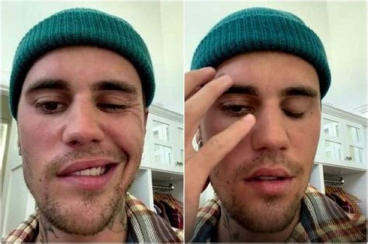 Justin Bieber’s face paralysis — what is Ramsay Hunt syndrome?