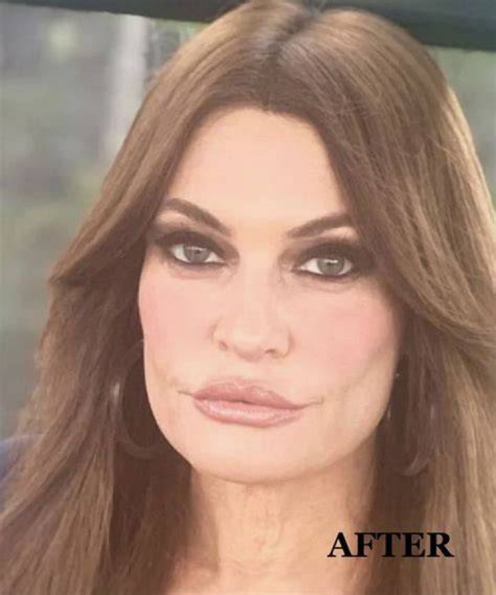 Kimberly Guilfoyle Plastic Surgery Kimberly Guilfoyle Face Before And