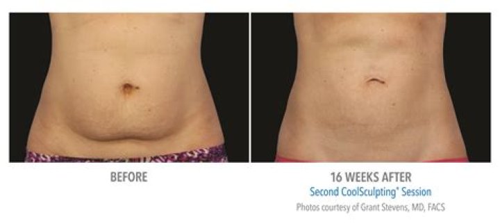 Should I Avoid CoolSculpting After Linda Evangelista's Reaction? Glowday