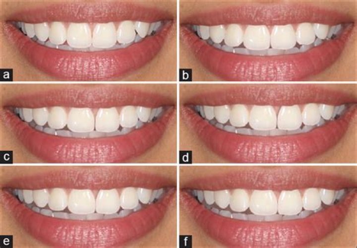 Teeth midline shift News Dentagama