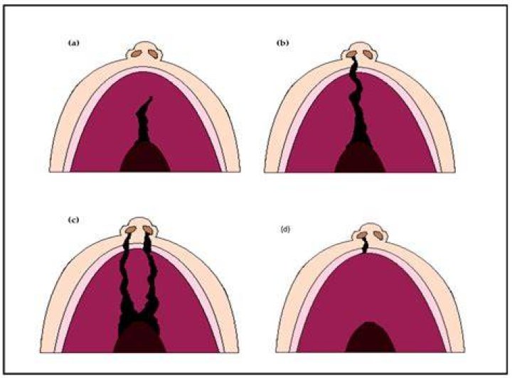 What’s an Orofacial Cleft? Cleft Lip and Cleft Palate Explained GoodRx